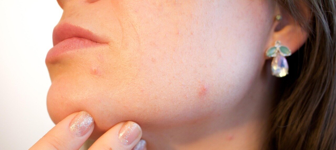 vrouw gezicht met acne littekens